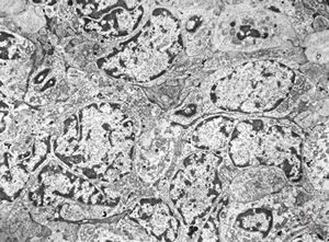 M,2y. | nephroblastoma (Wilms tumor)